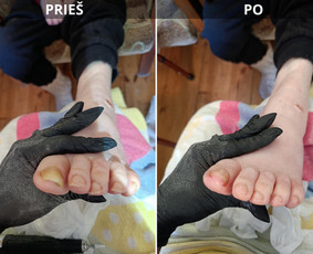 Probleminių nagų, padų, nuospaudų,varkymas jūsų namuose / Aida / Darbų pavyzdys ID 4267899