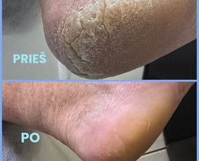 Manikiūras - Probleminių pėdų sprendimai - 1