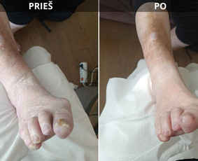 Probleminių nagų, padų, nuospaudų,varkymas jūsų namuose / Aida / Darbų pavyzdys ID 4290763