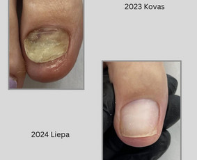 Manikiūras - Probleminis/estetinis pedikiūras - 1