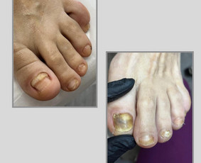 Manikiūras - Probleminis/estetinis pedikiūras - 2