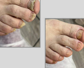 Manikiūras - Probleminis/estetinis pedikiūras - 3