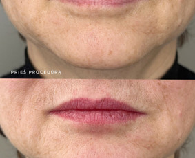 Lūpų permanentinis makiažas - Kristina Nalevaikienė Perla Muter - 4