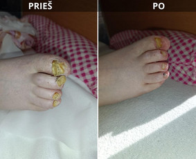 Grožio paslaugos - Probleminių nagų bei padų tvarkymas jūsų namuose - 1