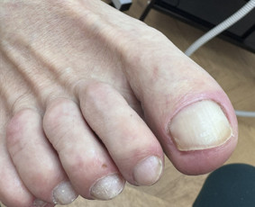 Manikiūras - Probleminių pėdų bei nagų tvarkymas / pedikiūras - 2