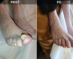 Manikiūras - Probleminių nagų, padų, nuospaudų,varkymas jūsų namuose - 3