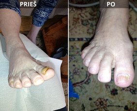 Manikiūras - Probleminių nagų, padų, nuospaudų,varkymas jūsų namuose - 2