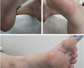 Manikiūras - Probleminių pėdų bei nagų tvarkymas / pedikiūras - 3