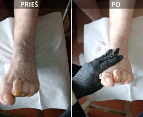 Grožio paslaugos - Probleminių nagų, padų, nuospaudų,varkymas jūsų namuose - 3