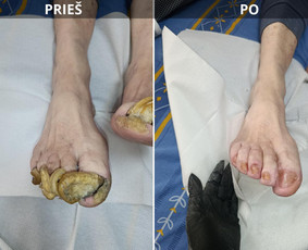 Grožio paslaugos - Probleminių nagų, padų, nuospaudų,varkymas jūsų namuose - 1