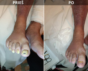 Aparatiniai manikiūrai - Probleminių nagų, padų, nuospaudų,varkymas jūsų namuose - 2