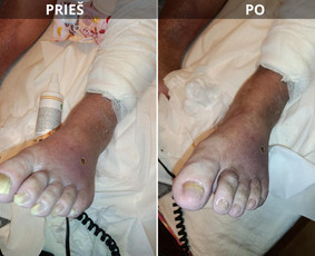 Aparatiniai manikiūrai - Probleminių nagų, padų, nuospaudų,varkymas jūsų namuose - 1