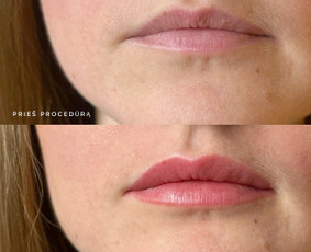 Lūpų permanentinis makiažas - Kristina Nalevaikienė Perla Muter - 4
