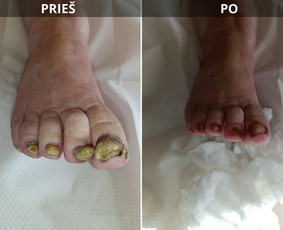 Manikiūras - Probleminių nagų, padų, nuospaudų,varkymas jūsų namuose - 4