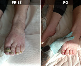 Manikiūras - Probleminių nagų, padų, nuospaudų,varkymas jūsų namuose - 3