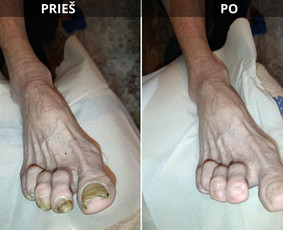 Manikiūras - Probleminių nagų, padų, nuospaudų,varkymas jūsų namuose - 2
