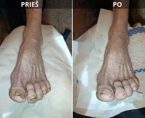 Manikiūras - Probleminių nagų, padų, nuospaudų,varkymas jūsų namuose - 1