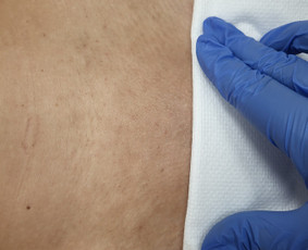 Depiliacija cukrumi - Lazerine epiliacija - 3