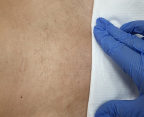 Depiliacija cukrumi - Lazerine epiliacija - 2