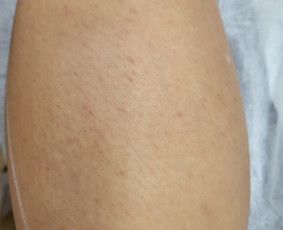 Depiliacija cukrumi - Lazerine epiliacija - 1