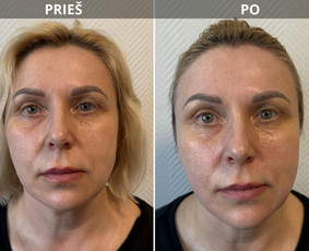 Bikini depiliacija - Kosmetologė - 4