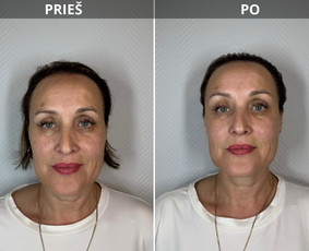 Bikini depiliacija - Kosmetologė - 3