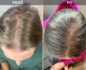 Bikini depiliacija - Kosmetologė - 2