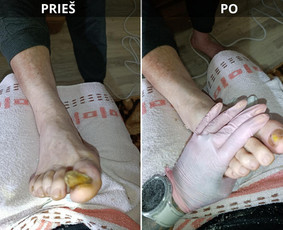 Grožio paslaugos - Probleminių nagų, padų, nuospaudų,varkymas jūsų namuose - 1