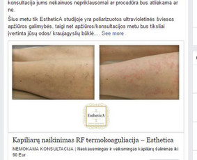 Esthetica grožio terapijos studija 
Prieš ir po |  Kapiliarų naikinimas vizualizacija iš nuotraukų telefonu | Aktyvus linkas į puslapį, bei į atskiras paslaugas