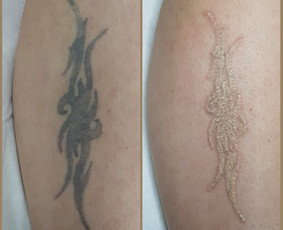 Tatuiruočių &scaron;alinimas - Auskarų vėrimas tiems, kurie renkasi save. - 4