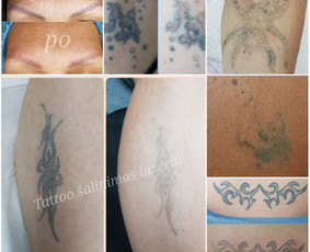 Tatuiruočių &scaron;alinimas - Auskarų vėrimas tiems, kurie renkasi save. - 3