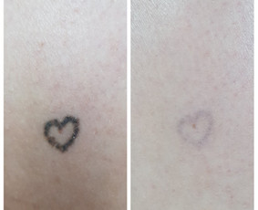 Tatuiruočių &scaron;alinimas - Auskarų vėrimas tiems, kurie renkasi save. - 2