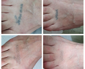 Tatuiruočių &scaron;alinimas - Auskarų vėrimas tiems, kurie renkasi save. - 1
