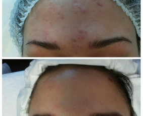 Rūgštinis veido valymas - Kosmetologė Klaipėdoje - 3