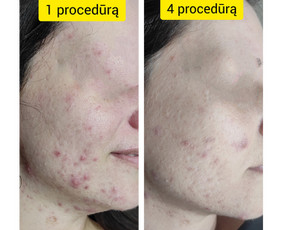 Rūgštinis veido valymas - Kosmetologė - 4