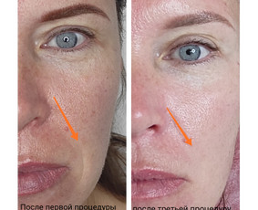 Beadatinė mezoterapija - Kosmetologė - 2