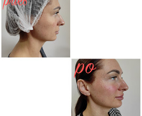 Kosmetologė - Biorevitalizacija - 2 Biorevitalizacija - Kosmetologė - 2