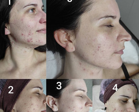 Rūgštinis veido valymas - Kosmetologė - 3
