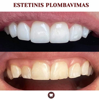 Estetinis plombavimas Klaipėda Preidenta nuotrauka 6