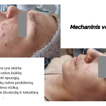 Mechaninis veido valymas Klaipėda Taisija Štrois nuotrauka 1