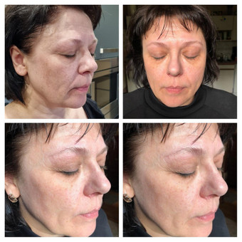 Biorevitalizacija Klaipėda Taisija Štrois nuotrauka 15
