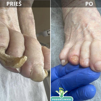 Problematiškų pėdų pedikiūras į namus. Vilnius Podoklinika nuotrauka 1