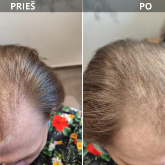 Terapija nuo plaukų slinkimo ir retėjimo/1,5h Kaunas Daiva Kibildienė nuotrauka 2