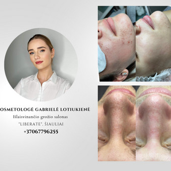 Kosmetologo konsultacija Šiauliai Kosmetologė Gabrielė Lotiukienė nuotrauka 6