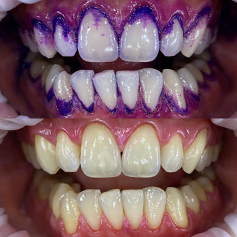 Profesionali burnos higiena Vilnius About Smile, UAB nuotrauka 6