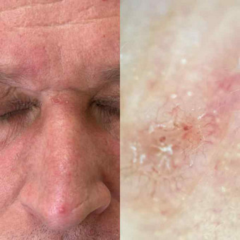 Nuotolinė dermatologo konsultacija Kaunas Orinta Klimaitė nuotrauka 2