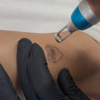 Tatuiroučių šalinimas lazeriu Klaipėda Viktorija Samsonė nuotrauka 6
