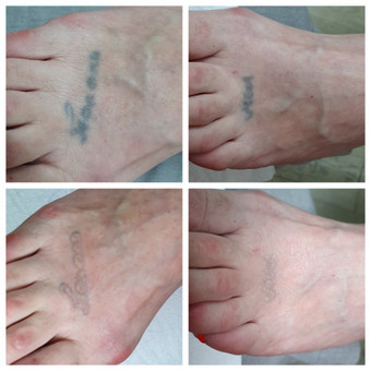 Tatuiruočių šalinimas Klaipėda Sandra Kuprytė nuotrauka 2